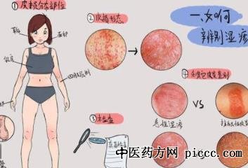 健康之路20220317:对付湿疹要打持久战,湿疹要不要忌口,白癜风
