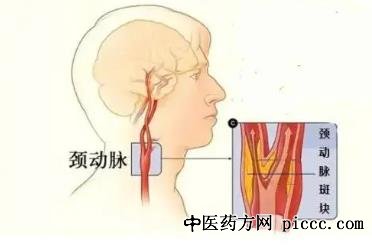 养生堂20220412:颈动脉斑块的类型与危险指数,李拥军,颈动脉斑块