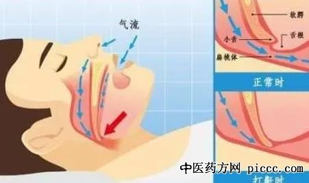 健康之路20220530:睡觉打呼震天响,祖凌云,睡眠呼吸暂停综合征