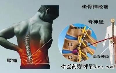 健康之路20220615:于峥嵘,中青年患腰突症,腰椎管狭窄病因到治疗