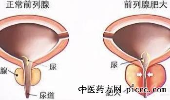 健康之路20220725:王建业,前列腺肥大,前列腺该如何保养