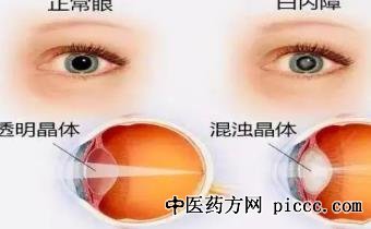 健康之路20220728:佘海澄,视网膜血管病变,晶状体混浊,糖尿病眼病