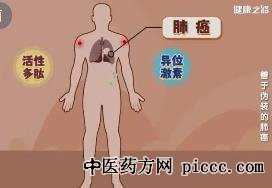 健康之路20220831:薛奇,肺癌善伪装,肺癌伪装成中风,肩周炎,腿痛