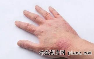 ½¡¿µÖ®Â·20220914:ÂíÁÕ,´òºÃʪÕî³Ö¾ÃÕ½,ʪÕîÖ¹Ñ÷,ÒýÆðʪÕîÔÒò