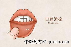 健康之路20220920:刘宏伟,口腔癌,口腔黏膜发白警惕可能是癌