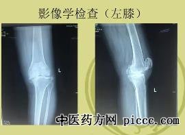 养生堂20221102:付中国,夏科氏关节病,肩周炎肩袖损伤,马明太