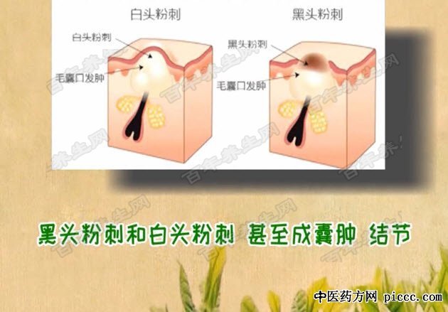 告别痘痘有妙招