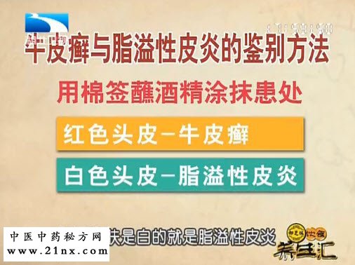 牛皮癣与脂溢性皮炎鉴别方法