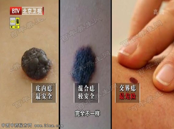 什么样的痣最危险