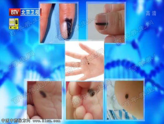 可能会癌变的痣