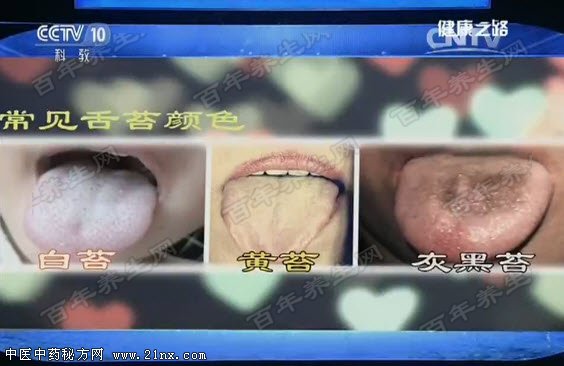 常见的舌苔颜色