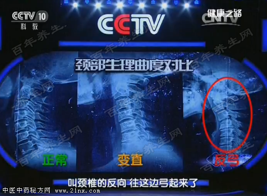 颈椎的生理曲度