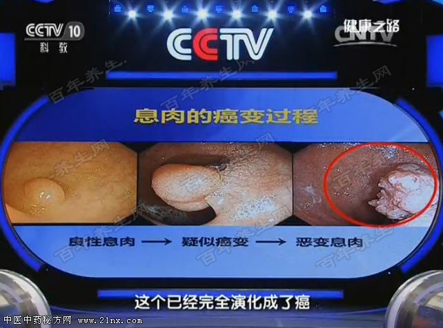 息肉的癌变过程