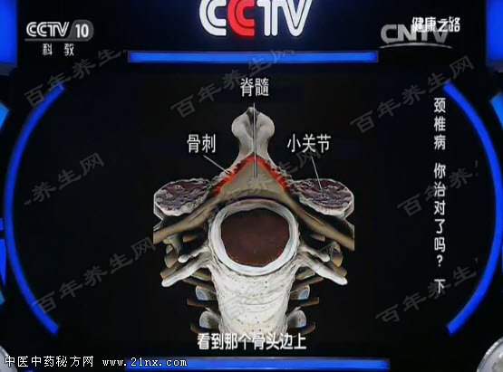 颈椎管狭窄是如何形成的