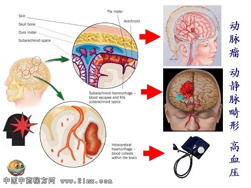 脑梗的高危因素