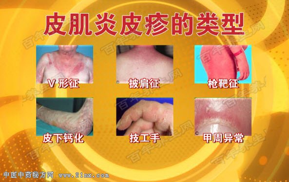 皮肌炎皮疹的类型
