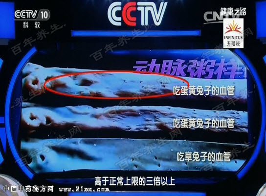 动脉粥样硬化的血管