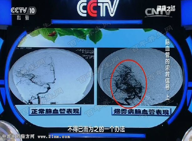 烟雾病患者的血管表现