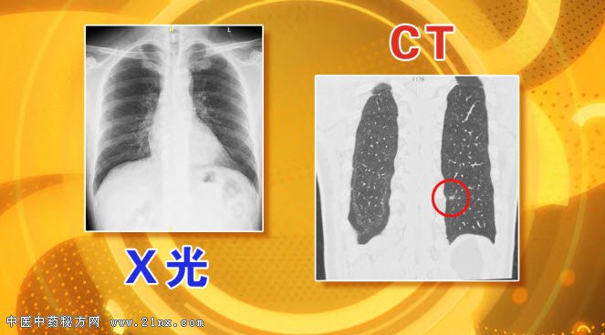 X光片与CT的区别