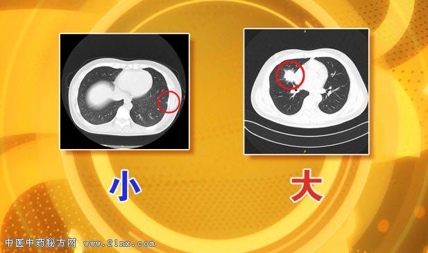 肺部结节大与小