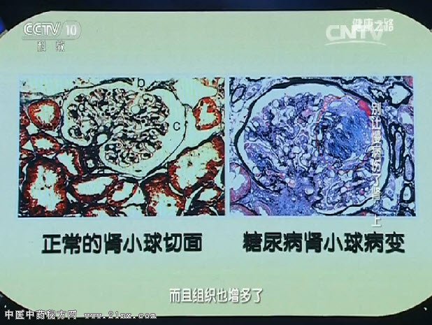 正常人的肾小球和糖尿病患者的肾小球