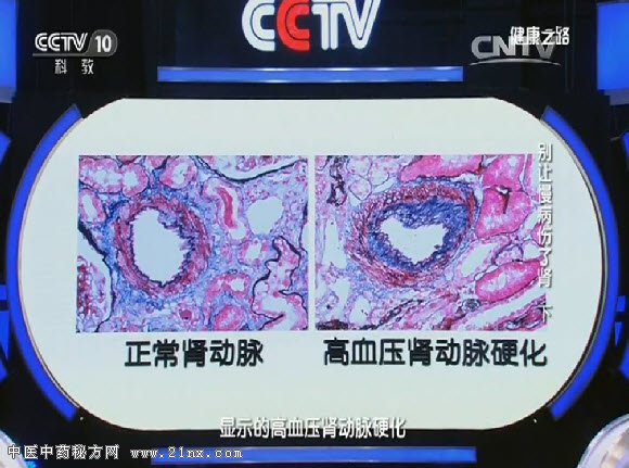 正常人肾动脉与高血压患者的肾动脉对比