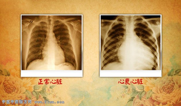 正常心脏和心衰心脏