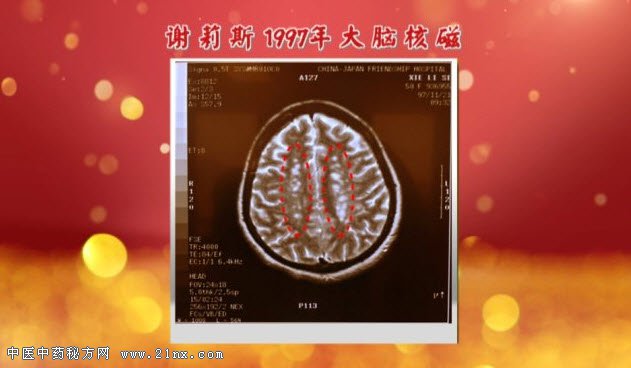 谢莉斯大脑核磁