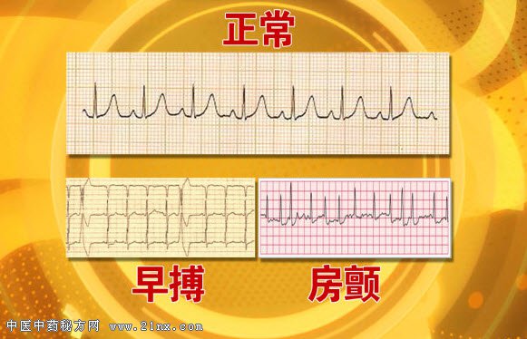 怎么界定和判断哪种早搏需要治疗