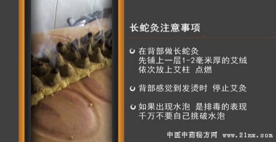 长蛇灸的注意事项