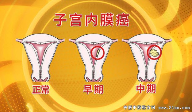 子宫内膜癌的分期