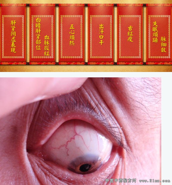 肝肾阴虚的症状