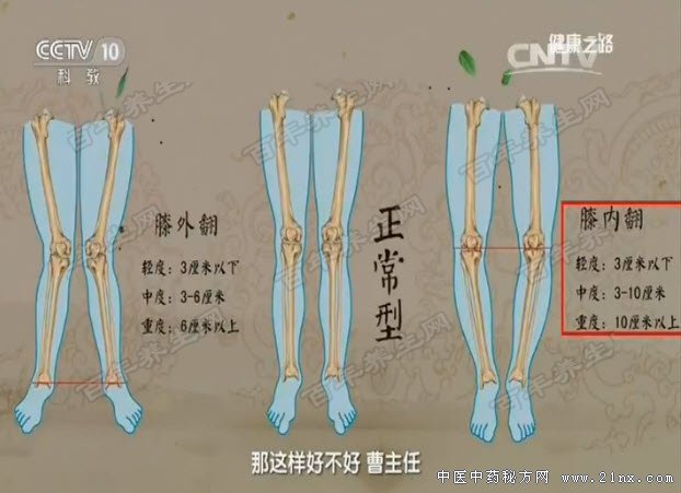 膝内翻和膝外翻