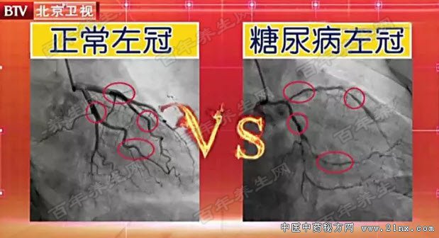 糖尿病的心血管