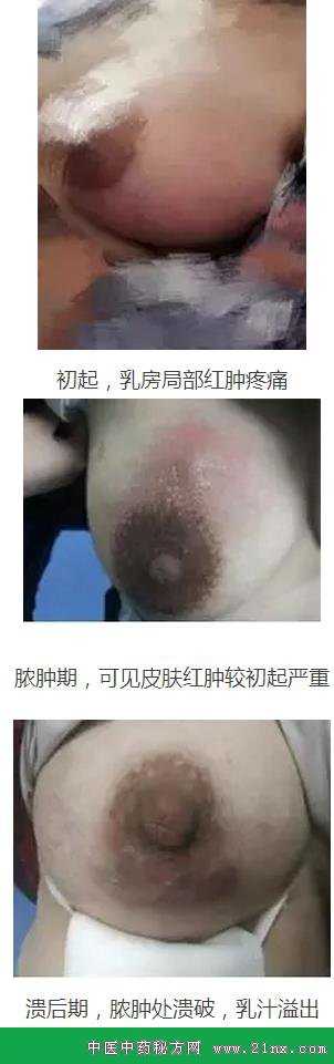 急性乳腺炎