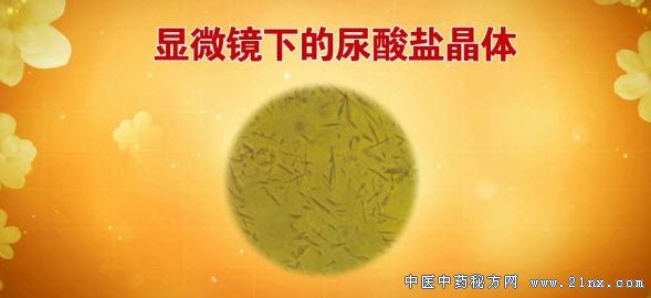 显微镜下的尿酸晶体