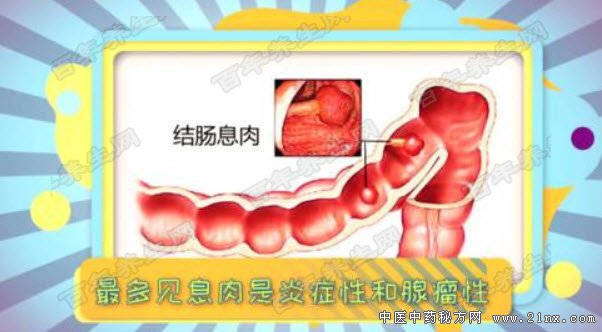 结肠息肉