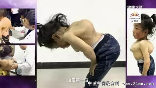 健康之路20180305《良医大爱塑脊梁》脊柱侧弯