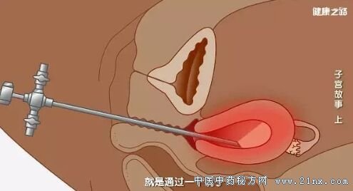 健康之路20180306《子宫故事》(上)子宫内膜癌