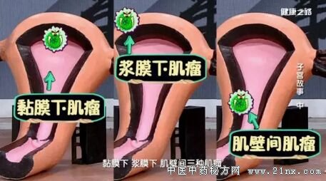 健康之路20180307《子宫故事》(中)子宫肌瘤